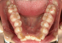 症例③　下顎の叢生　抜歯のケース　20代女性
