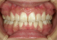 症例③　下顎の叢生　抜歯のケース　20代女性