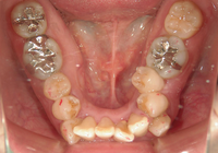 症例④　重度の叢生　非抜歯のケース　40代女性