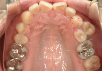 症例④　重度の叢生　非抜歯のケース　40代女性