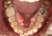 症例⑤　下顎の叢生　非抜歯のケース　40代女性