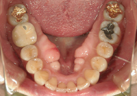 症例⑤　下顎の叢生　非抜歯のケース　40代女性