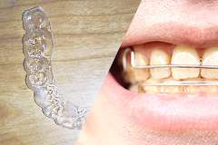 列 ピース マウス 歯 矯正 前歯の出っ歯はマウスピース矯正で治せる？